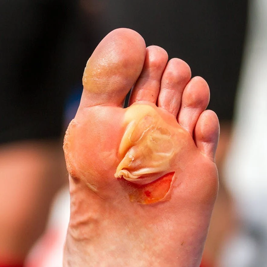 Frequent Shoe Blisters - Reduce Friction With Better Fit